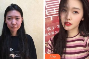 福州市鼓樓醫(yī)院整形美容中心張睅理整形價(jià)格表附埋線提升手術(shù)案例展示