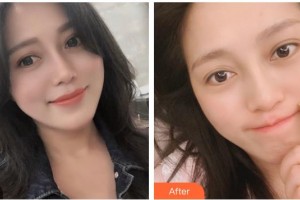 福州艾尚美醫(yī)療美容門診部楊堅(jiān)整形價(jià)格表附熱瑪吉案例展示