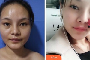 福州時(shí)匠醫(yī)療美容門診部鄭榮福整形價(jià)格表附面部脂肪填充案例展示