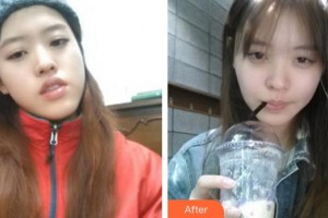 福州艾尚美醫(yī)療美容門診部桂新文整形價(jià)格表附自體脂肪全臉填充案例展示