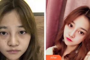 福州眼科醫(yī)院王崢整形價(jià)格表附眼部手術(shù)案例展示