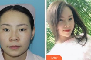 福州眼科醫(yī)院陳平整形價(jià)格表附雙眼皮案例展示