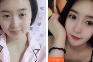 福州眼科醫(yī)院王艷整形價格表附眼部整形案例展示