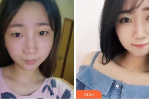 福州眼科醫(yī)院鄭玉炎整形價(jià)格表附自然雙眼皮案例展示