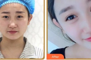 福州眼科醫(yī)院張琳整形價格表附雙眼皮案例展示