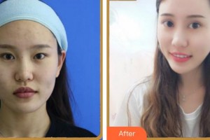 福州眼科醫(yī)院劉默爾整形價格表附眼部整形案例展示