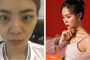 福州東南眼科醫(yī)院吳欽玲整形價格表附雙眼皮修復案例展示