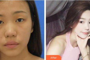 福州東南眼科醫(yī)院胡敏芝整形價(jià)格表附眼部手術(shù)案例展示