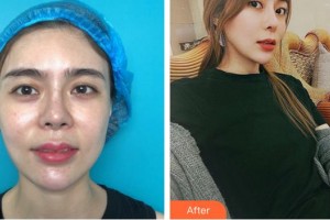 福州東南眼科醫(yī)院洪我象整形價(jià)格表附我的整形經(jīng)歷案例展示