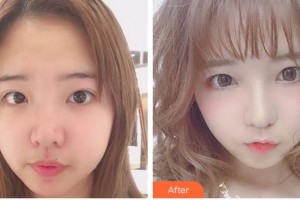 福州東南眼科醫(yī)院陳瑋整形價(jià)格表附眼部整形案例展示