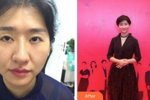 福州東南眼科醫(yī)院王爽整形價(jià)格表附雙眼皮修復(fù)案例展示