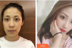 福州東南眼科醫(yī)院陳良桔整形價(jià)格表附眼部綜合案例展示