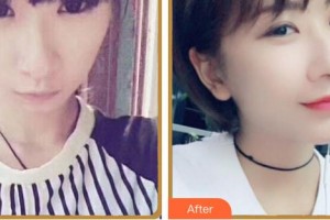 福州東南眼科醫(yī)院黃飛整形價(jià)格表附眼部綜合案例展示