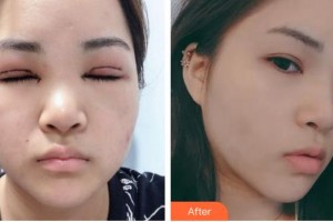 福州東南眼科醫(yī)院趙曉春整形價格表附眼部整形案例展示