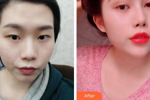 福州東南眼科醫(yī)院鄭建亮整形價(jià)格表附切開雙眼皮案例展示