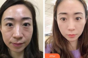 福州東南眼科醫(yī)院李圣請整形價(jià)格表附不開刀去眼袋+淚溝填充案例展示