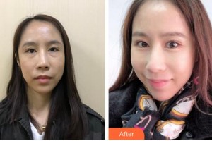 福州東南眼科醫(yī)院林興中整形價(jià)格表附不開刀去眼袋+淚溝填充+收緊案例展示