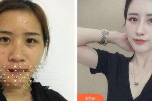 福州東南眼科醫(yī)院陳元整形價格表附眼部手術、鼻部手術，多方面部脂肪填充案例展示