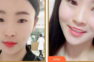 福州東南眼科醫(yī)院劉秀珍整形價格表附眼部修復案例展示