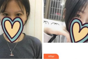 福州東南眼科醫(yī)院于麟整形價格表附get新技能較強眼妝眼部手術案例展示