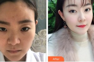 福州東南眼科醫(yī)院謝威義整形價格表附眼部手術案例展示