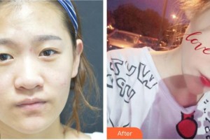 福州東南眼科醫(yī)院黃可進整形價格表附成為雙眼皮女孩-雙眼皮案例展示