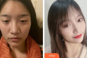 福州東南眼科醫(yī)院陳正勇整形價格表附眼部整形案例展示