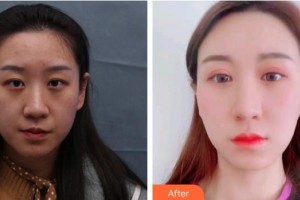 福州東南眼科醫(yī)院吳國瑋整形價格表附埋線重瞼修復+內(nèi)眥開大術案例展示