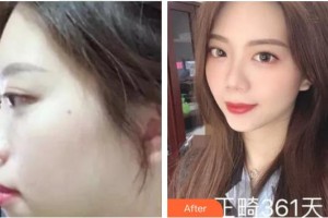 福州三顆牙口腔門診部許積紅整形價格表附骨性齙牙妹氣質UPUPUP案例展示