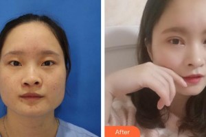 福州東南眼科醫(yī)院周成銀整形價(jià)格表附全切雙眼皮案例展示