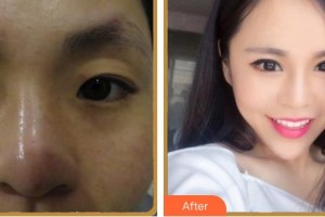 福州愛爾眼科醫(yī)院姚明君整形價格表附眼部整形案例展示