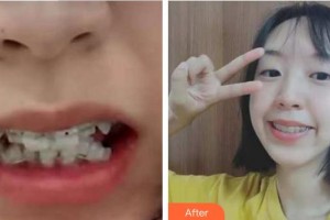 福州東南口腔醫(yī)院李明考整形價格表附牙齒矯正案例展示