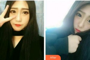 福州維樂(lè)口腔門診部林錦整形價(jià)格表附牙齒隱形矯正案例展示