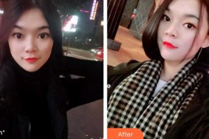 福州美可普口腔門診部姚紅梅整形價(jià)格表附牙齒隱形矯正案例展示