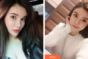 福州愛尚貝臣口腔門診部羅維明整形價(jià)格表附超聲波潔牙案例展示