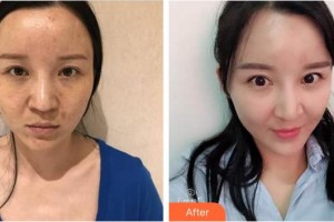 廈門華美名媛整形美容醫(yī)院李平珍整形價格表附自體脂肪面部填充案例展示