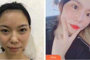 廈門蘭的整形外科門診部張玉娟整形價格表附埋線雙眼皮+去脂案例展示