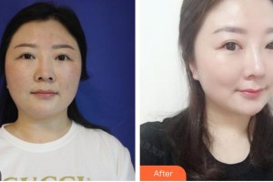 廈門莫琳娜醫(yī)療美容門診部邊大偉整形價(jià)格表附鼻修復(fù)改鼻案例展示