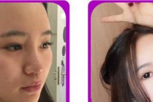 廈門市第一醫(yī)院思明分院整形外科徐洋整形價(jià)格表附鼻部整形案例展示