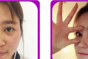 廈門華美名媛整形美容醫(yī)院謝常禮整形價(jià)格表附鼻部整形案例展示