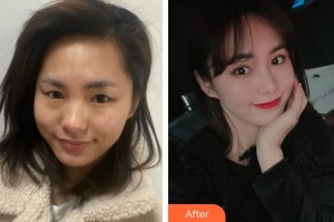 廈門張銘整醫(yī)療美容診所林潮整形價(jià)格表附眼部綜合案例展示