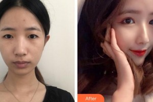 廈門張銘整醫(yī)療美容診所陳明整形價(jià)格表附眼部整形案例展示