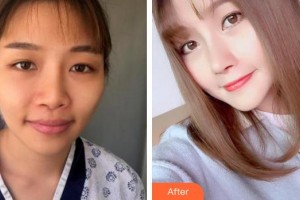 廈門莫琳娜醫(yī)療美容門診部王海濤整形價格表附鼻部手術(shù)案例展示