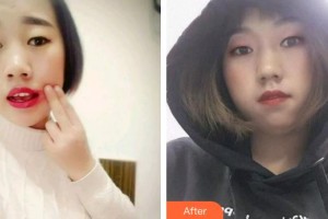 廈門海峽整形美容醫(yī)院袁靜明整形價格表附牙齒根管調(diào)節(jié)案例展示