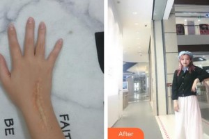 廈門大學(xué)附屬東南醫(yī)院燒傷整形科蔡少甫整形價格表附增生疤痕案例展示