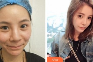 廈門市第一醫(yī)院思明分院整形外科許春鵬整形價格表附鼻部多項(xiàng) 日式自然鼻案例展示