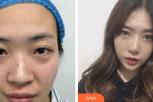 廈門莫琳娜醫(yī)療美容門診部黃星諺整形價格表附超激光美膚細(xì)膩膚質(zhì)案例展示