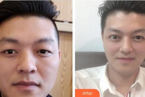 廈門莫琳娜醫(yī)療美容門診部林逸群整形價格表附即變男神，無關(guān)痛癢案例展示