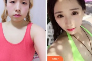 廈門銀河整形美容醫(yī)院羅海明整形價格表附胸部案例展示