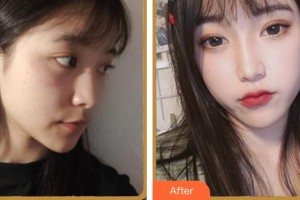 廈門銀河整形美容醫(yī)院劉喻筼整形價格表附面部提升案例展示